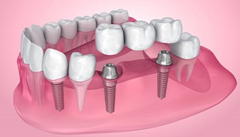 Illustration of dental implants with crown and bridge