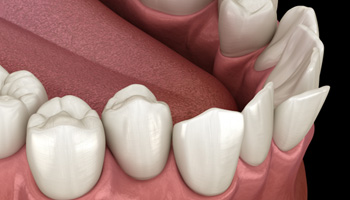 Illustration of crowded teeth