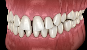 Illustration of gapped teeth