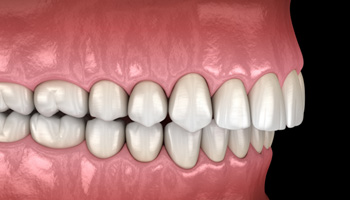 Illustration of an overbite