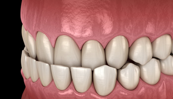 Illustration of an underbite