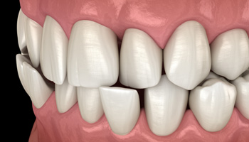 Illustration of a crossbite