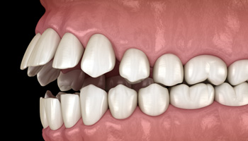 Illustration of an open bite