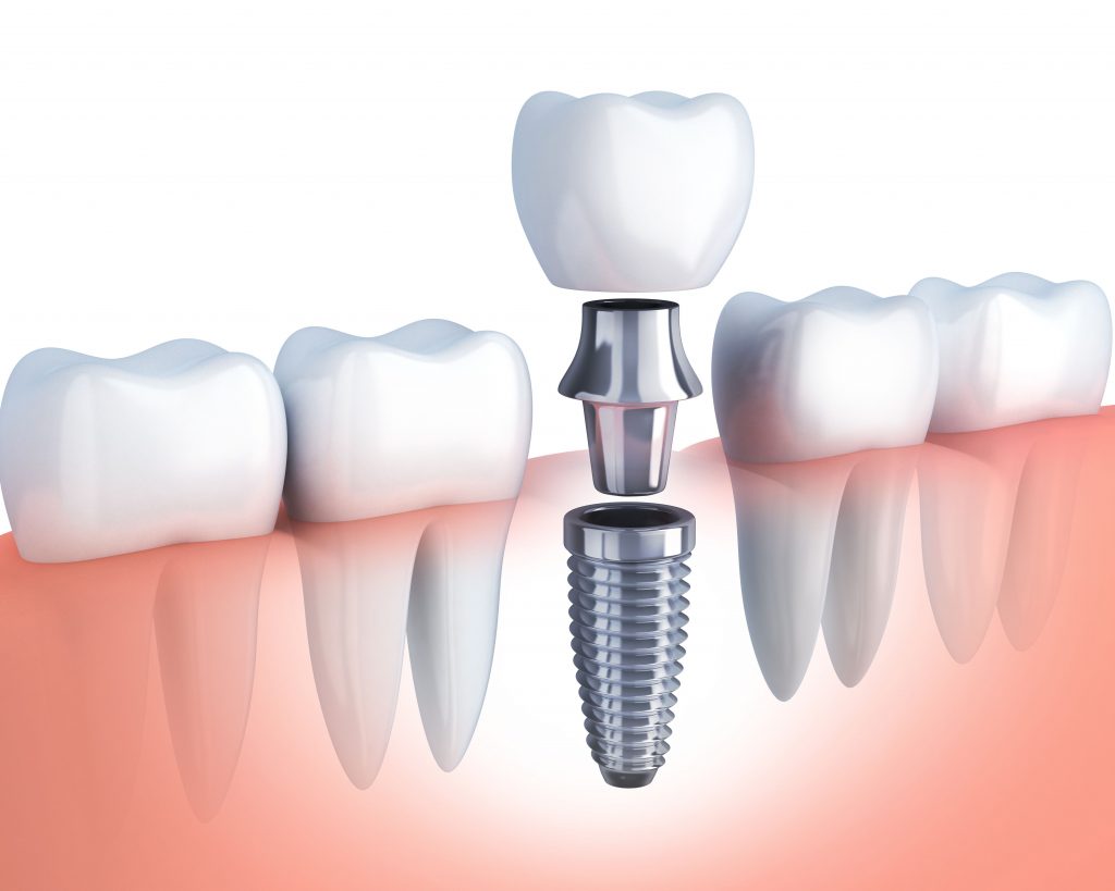 implant diagram - Danville Dental Associates Blog